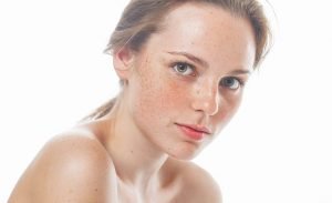 そばかすの原因はメラニン色素と遺伝！そばかす発生のメカニズム